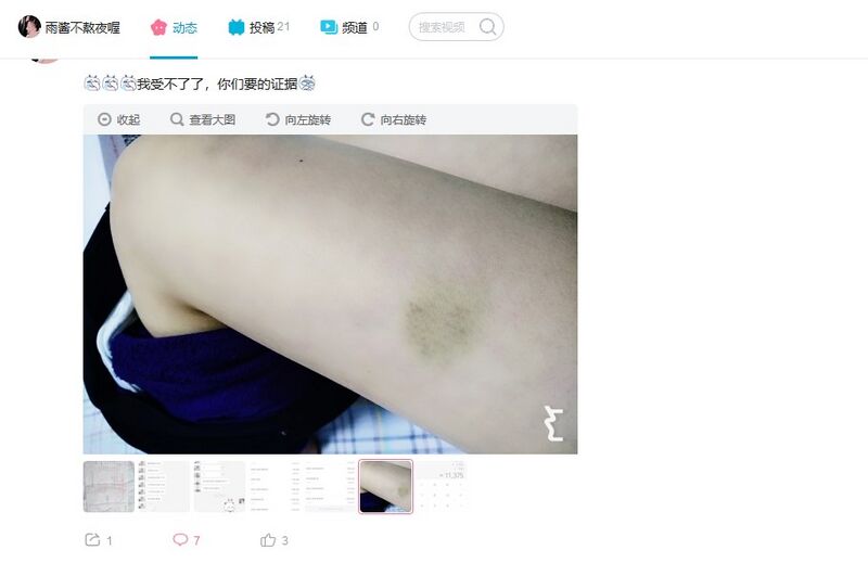 文件:自残伤痕.jpg
